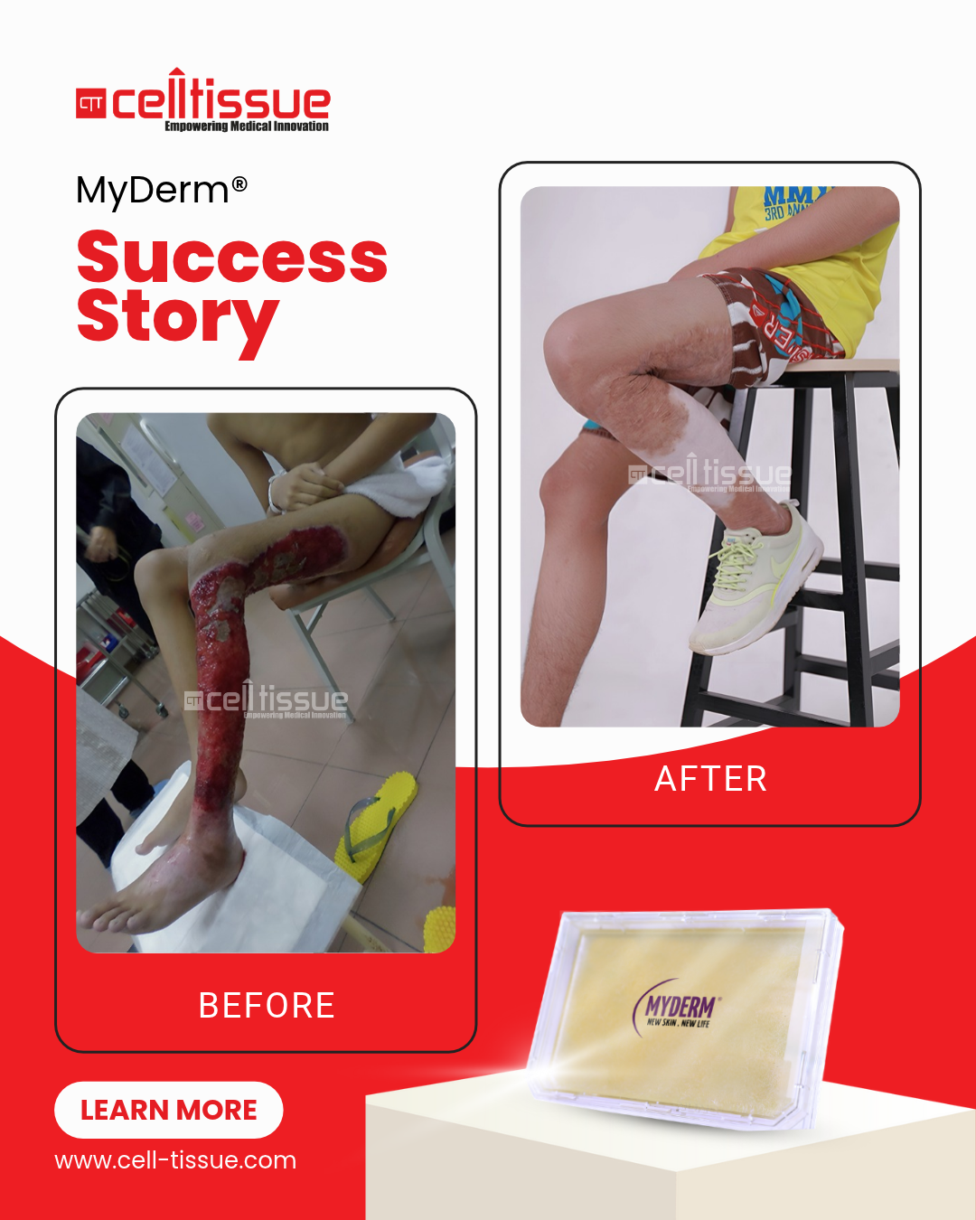 [PATENTED TECHNOLOGY] MyDerm®